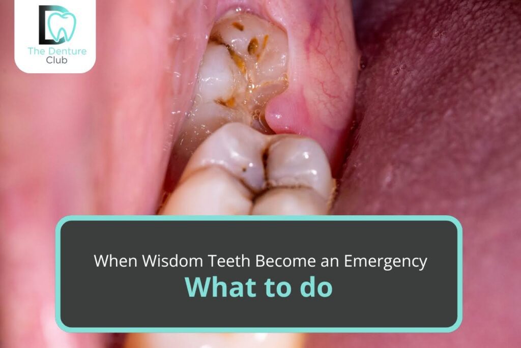 When Wisdom Teeth Become an Emergency- What to Do