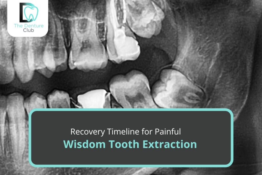 Recovery Timeline for Painful Wisdom Tooth Extraction