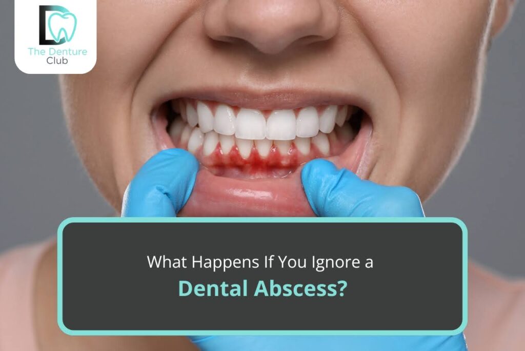 What Happens If You Ignore a Dental Abscess?